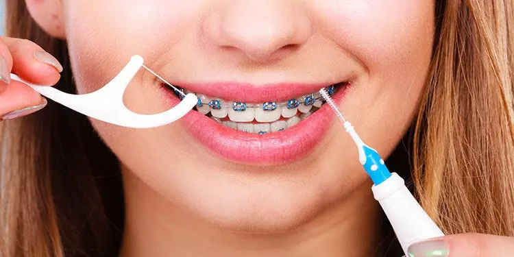 Braces Care.jpg.web .750